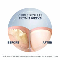 Scholl Kalknagel Behandelset -TENA || Metagenics || Now Winkel 1053908 6